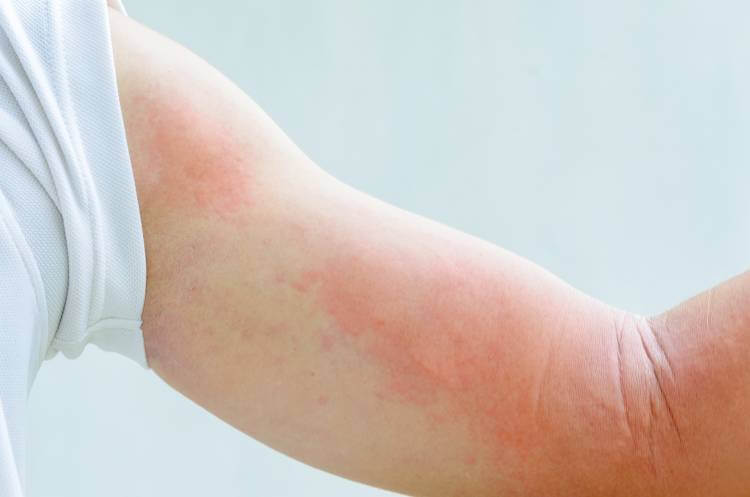 Может ли быть аллергия на воду - симптомы проявления