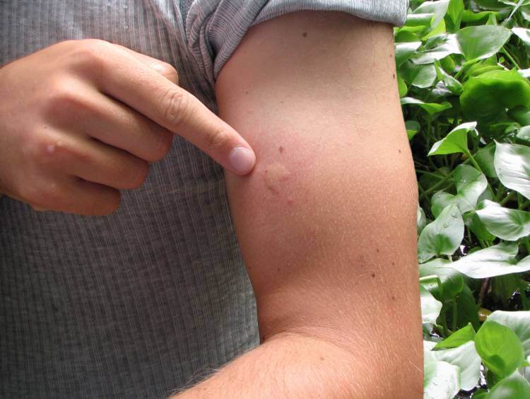 Симптомы аллергии на укусы комаров