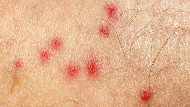 Аллергический отек на укус комара