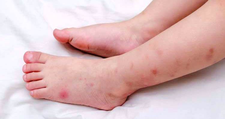 Аллергический отек от укуса комара у ребенка