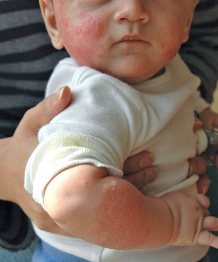 Симптомы аллергии на яйца у ребенка