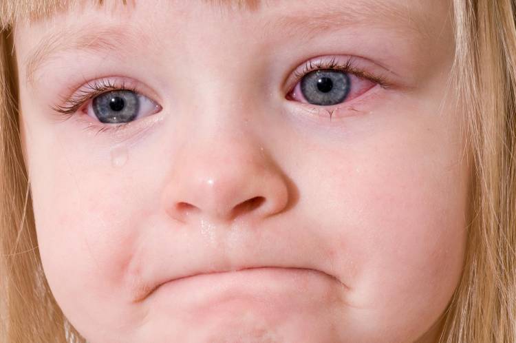 Фото аллергия на клубнику у детей