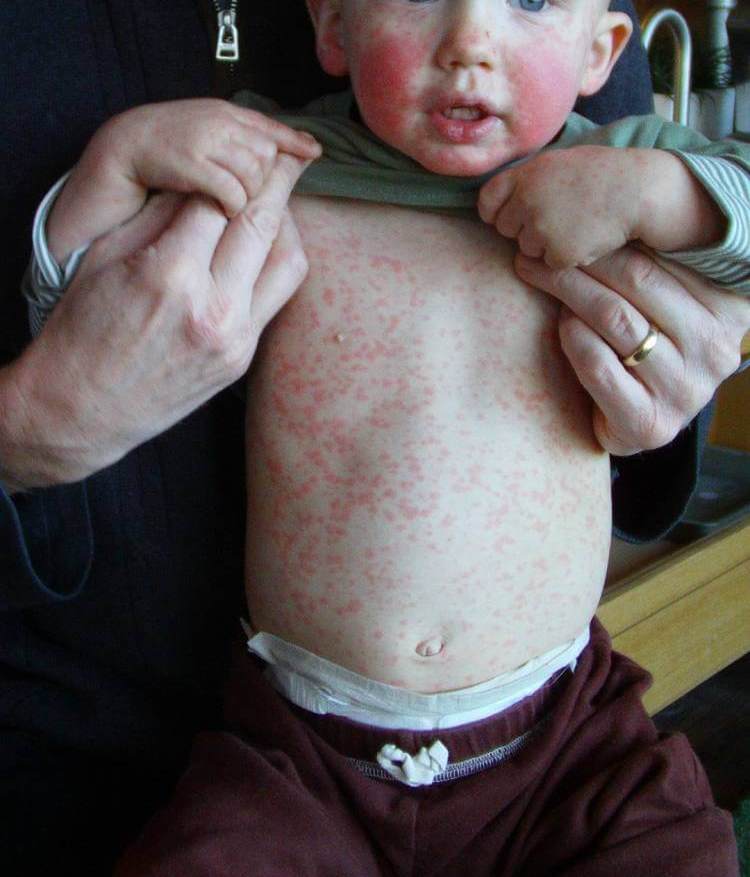 Фото аллергия на клубнику у детей