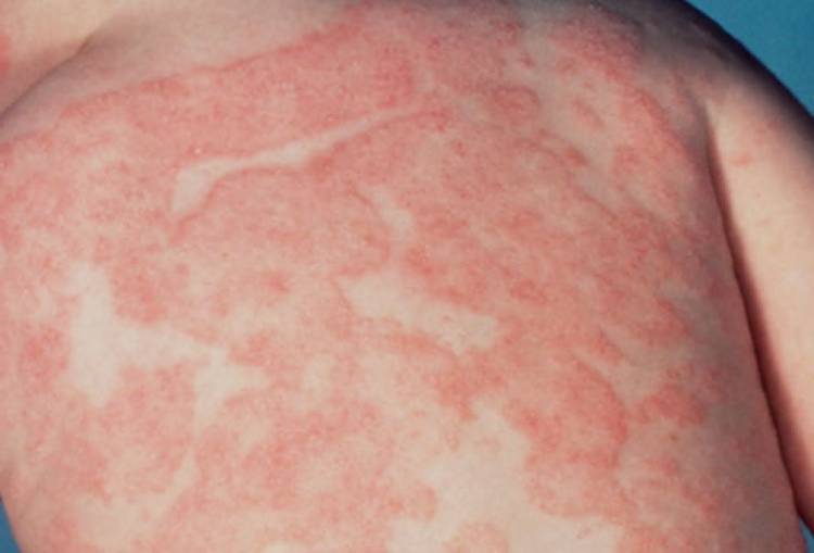 Аллергия на коровий белок у грудничка симптомы при гв фото