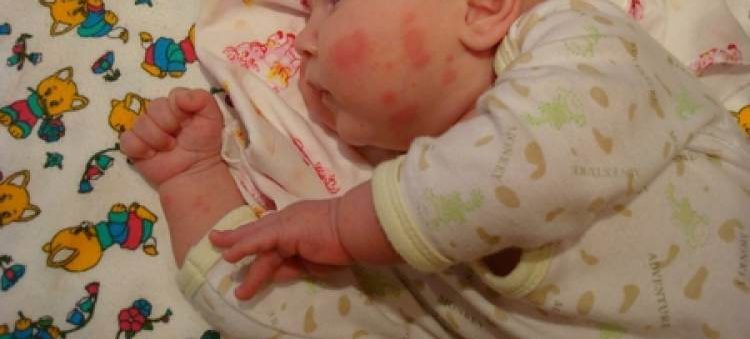 Как проявляется аллергия на молоко у детей