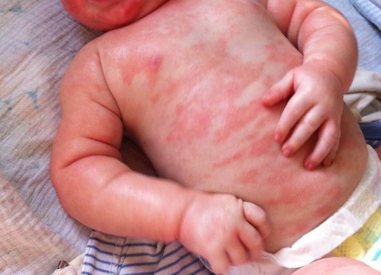 Как проявляется аллергия на молоко у детей фото