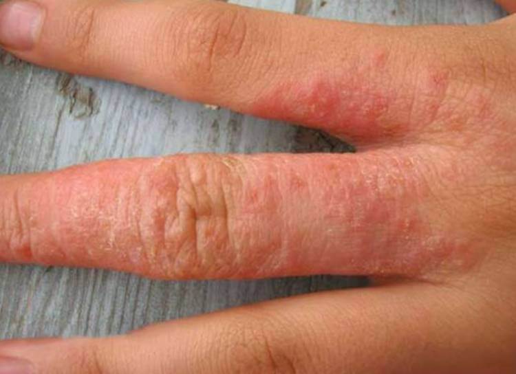 Аллергия на моющие средства симптомы