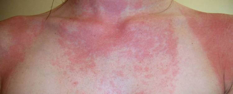 Симптомы аллергии на солнце