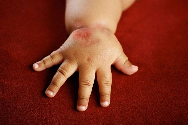 Фото аллергия у ребенка на Глютен