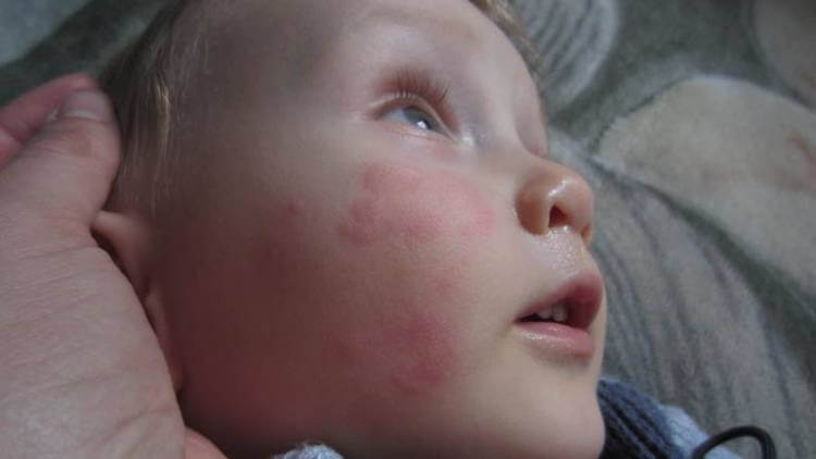 Симптомы аллергии на холод у детей