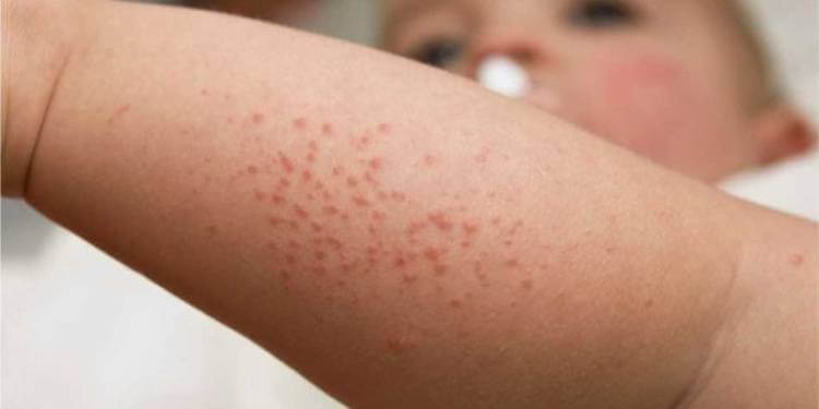 Симптомы аллергии на Нурофен у детей
