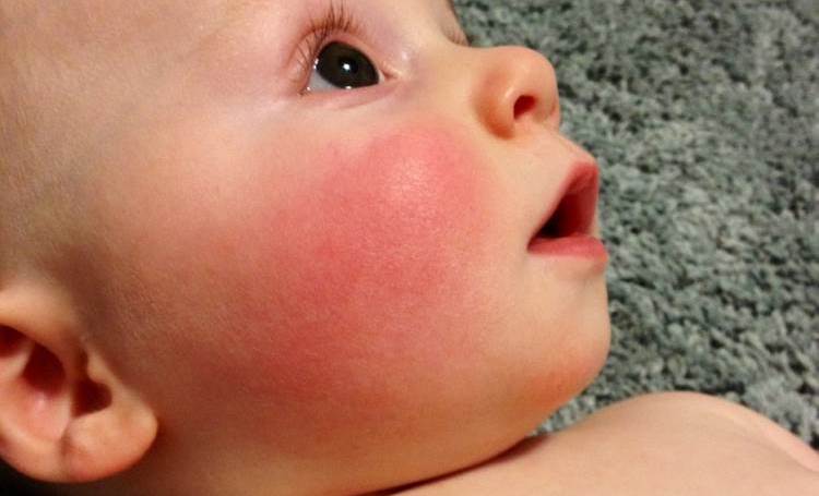 Фото: аллергия на детский Нурофен