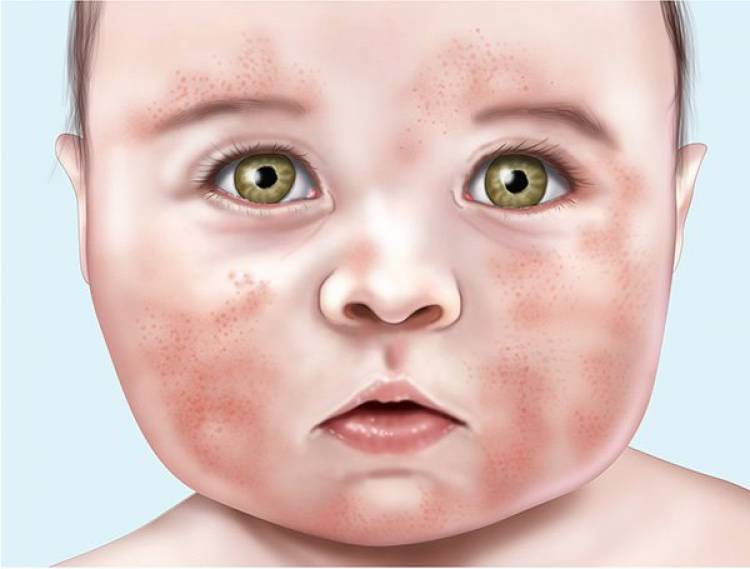 Симптомы аллергии на березу у ребенка фото