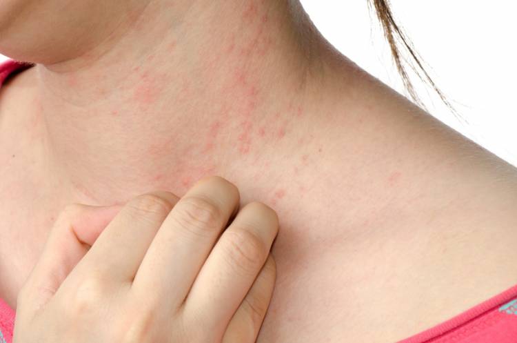 Аллергия на глютен – симптомы