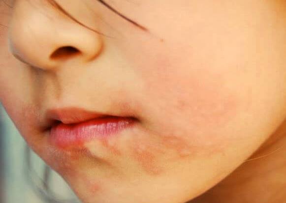 Аллергия на черешню фото
