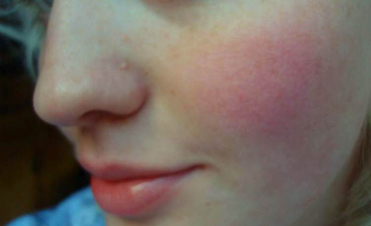 Как убрать красные пятна на лице при аллергии