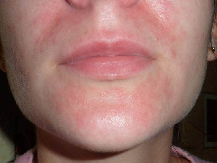 Аллергия на лице в виде пятна