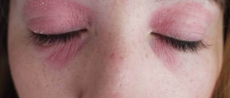 Аллергия лицо красное горит пятна