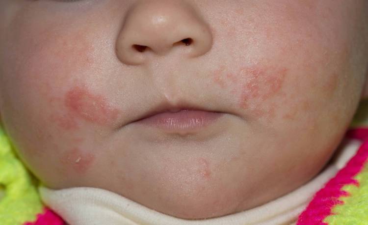 Аллергия на коже лица красные пятна
