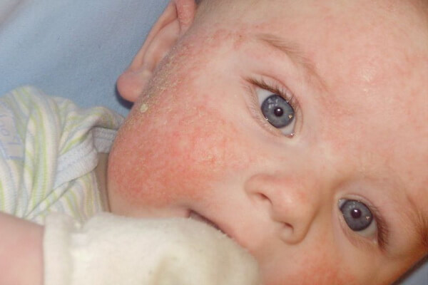 Фото пищевой аллергии у ребенка