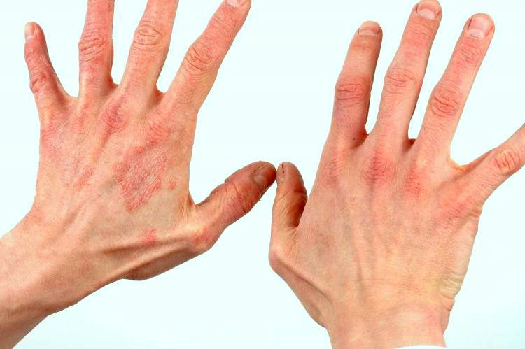 Аллергия на руках в виде красных пятен и чешется чем лечить