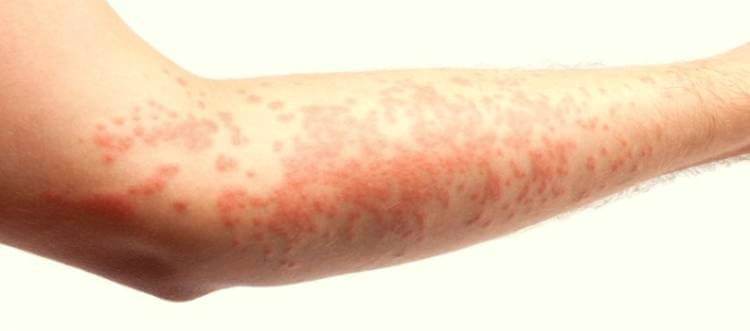Аллергия красные пятна руках и ногах