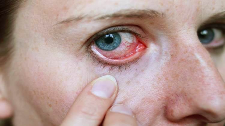 Симптомы аллергии на стиральный порошок