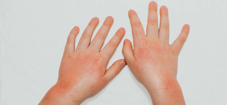 Покраснение рук при аллергии на стиральный порошок