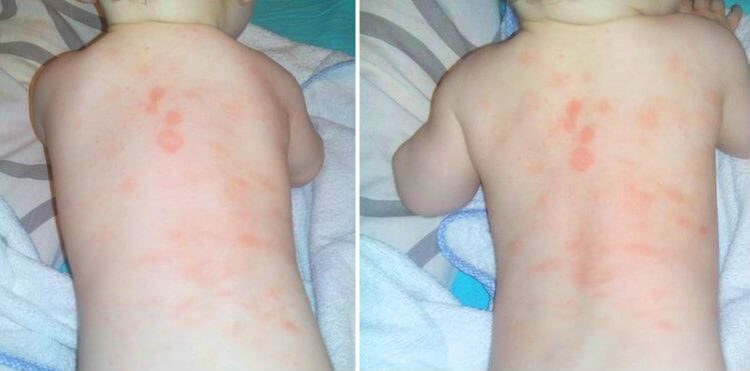 Как проявляется аллергия на порошок фото