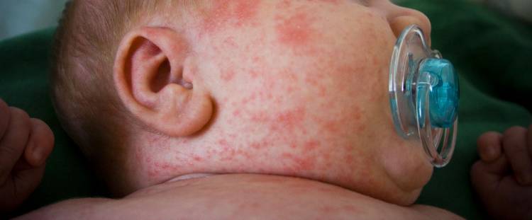 Фото: Как выглядит аллергия на лице у грудничка 
