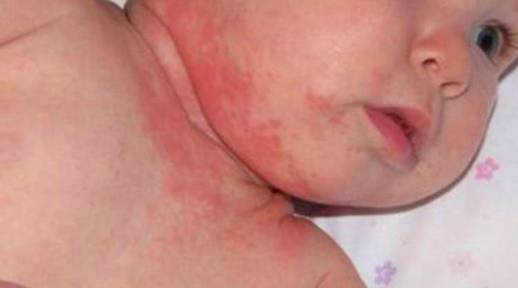 Атопический дерматит у детей хроническая форма