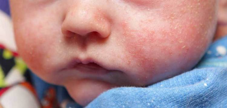 Симптомы атопического дерматита у детей