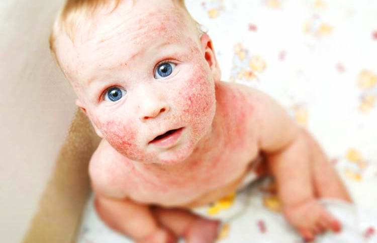 атопический дерматит у ребенка фото