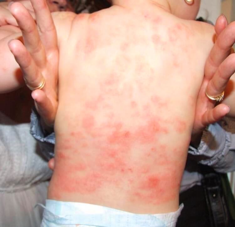 Аллергия на стиральный порошок у детей