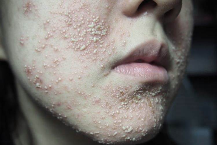 Аллергия на лице от косметики