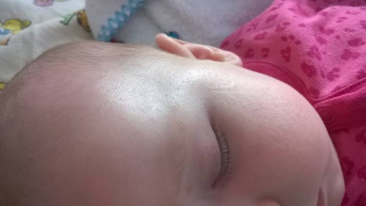 Сыпь от аквадетрима у новорожденного