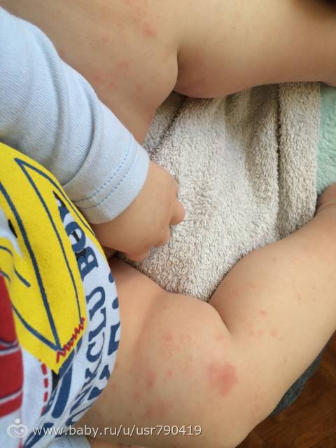 Аквадетрим аллергия у детей фото сыпь