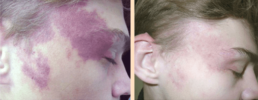 Аллергия на коже лица красные пятна