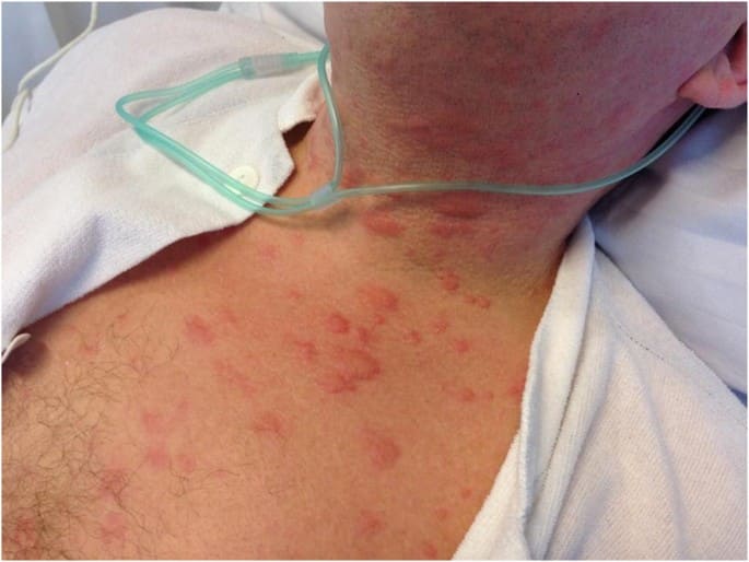 Аллергия на хлоргексидин симптомы